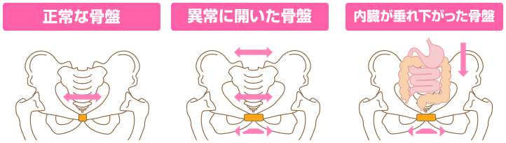 骨盤の状態